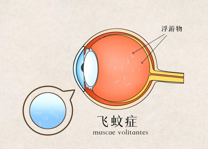 飞蚊症是怎么回事？与这4种原因有关
